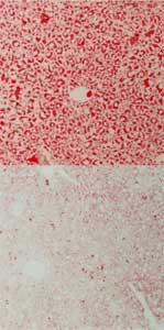 Nonalcoholic Fatty Liver Disease