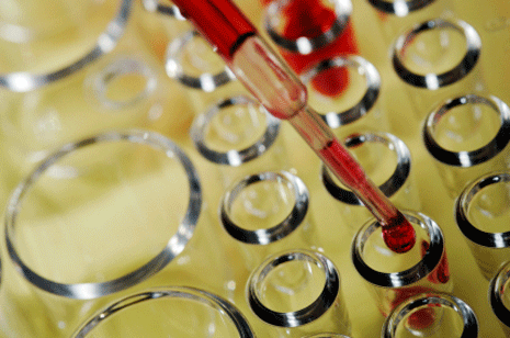 Blood Tests showed XMRV Retrovirus at CFS Patients