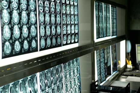 Gehirn zeigt Auffälligkeiten bei MCS-Patienten
